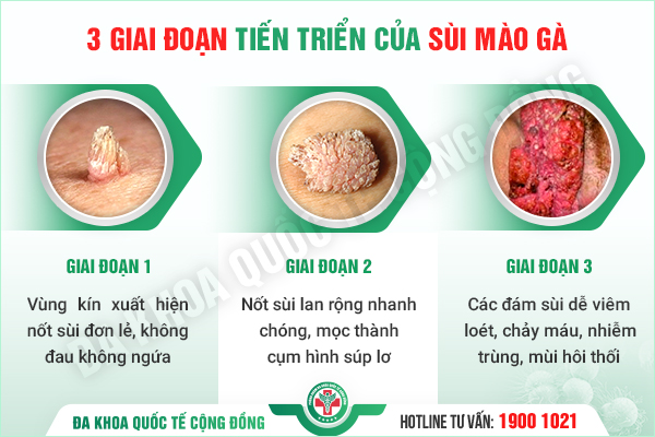 Những yếu tố quyết định hiệu quả của việc điều trị sùi mào gà