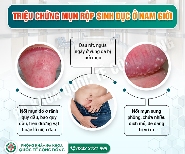 Mụn rộp sinh dục