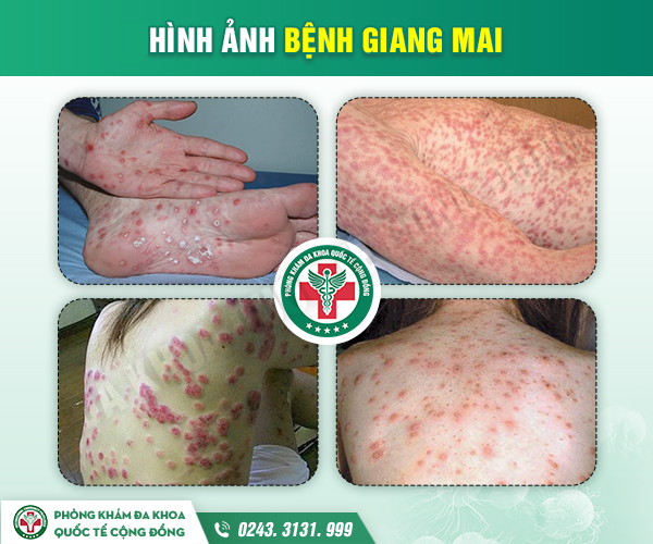 Bệnh giang mai