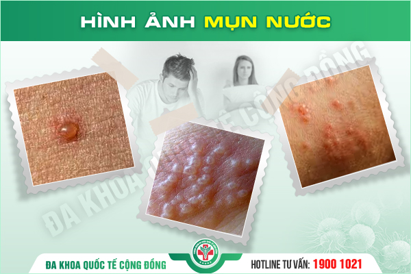 Dương vật nổi mụn nước – Dấu hiệu nhỏ, mối họa lớn!