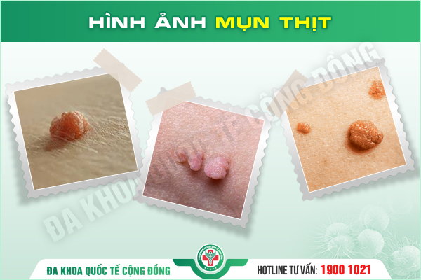 Mụn thịt âm đạo – Dấu hiệu tưởng nhỏ nhưng nguy hiểm ở vùng kín!