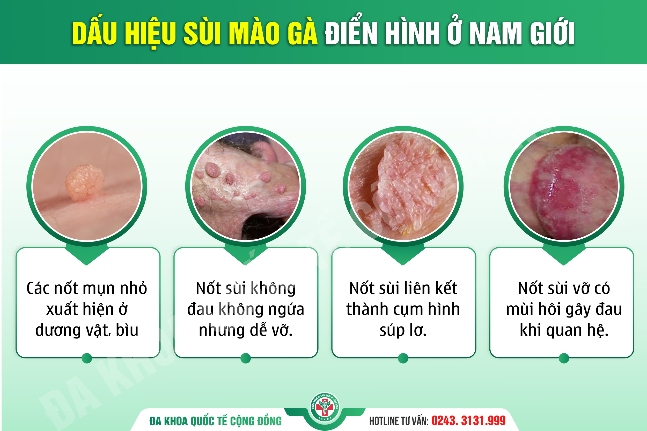 Mụn cóc sinh dục nữ: Những góc nhìn tiệm cận giúp loại bỏ ngộ nhận phổ biến