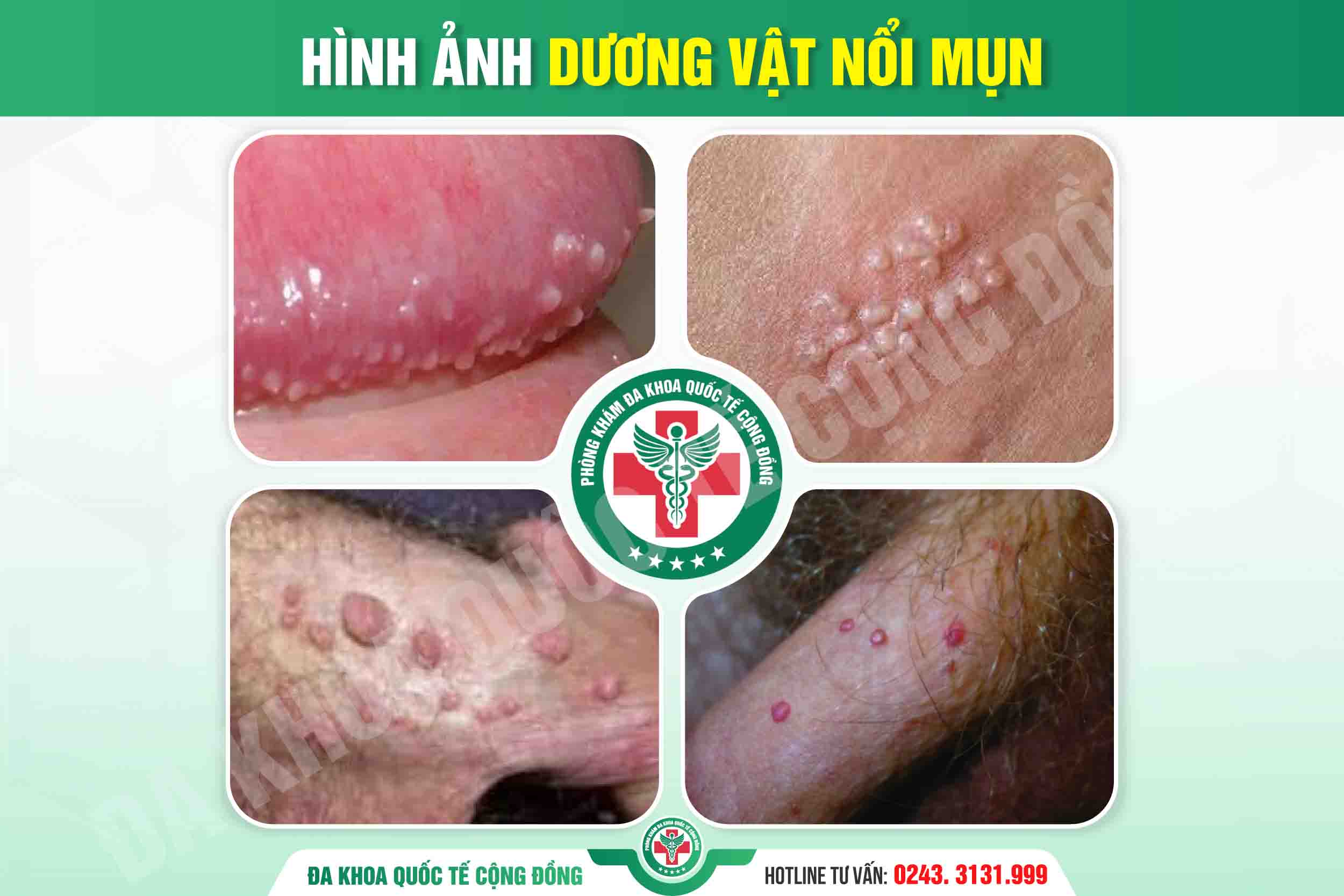 Dương vật nổi mụn – dấu hiệu nhỏ, biến chứng lớn