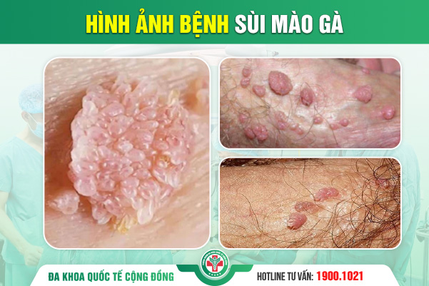 Mụn vùng kín – Dấu hiệu cảnh báo bệnh xã hội: Đừng chủ quan!