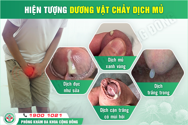 Dương vật chảy mủ là bệnh gì? Cảnh báo dấu hiệu nhiễm khuẩn nguy hiểm