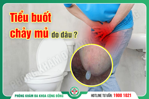 Tiểu buốt chảy mủ – Lời cầu cứu của cơ thể mà bạn không nên phớt lờ