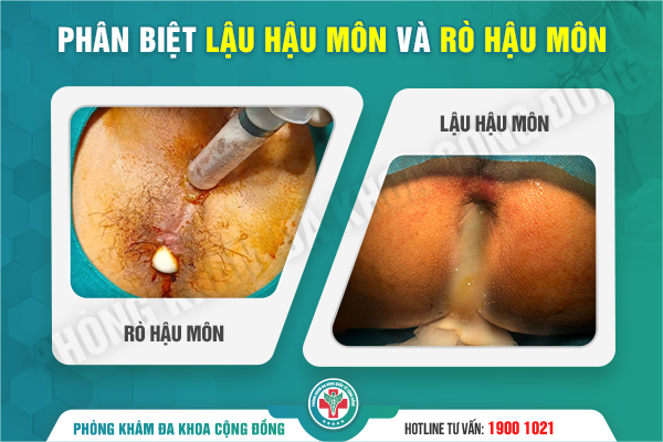 Bệnh lậu ở hậu môn – Chuyên gia cảnh báo về bệnh lý ngày càng phổ biến