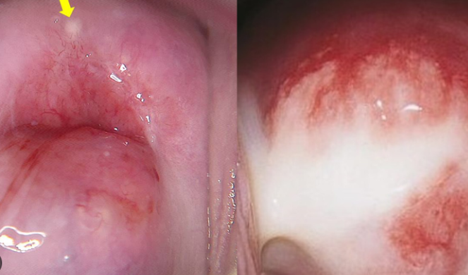 Âm đạo chảy mủ xanh vàng – Đừng tự chữa, tham khảo ngay phác đồ điều trị chuyên sâu của bác sĩ
