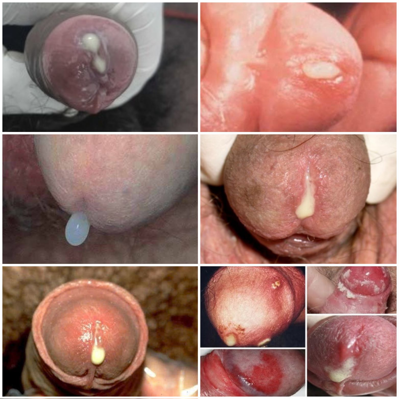 Tiểu Ra Mủ Trắng Đục, Vàng Xanh: Dấu Hiệu “Tố Cáo” Bệnh Xã Hội Nguy Hiểm Cùng Nhóm Với HIV!